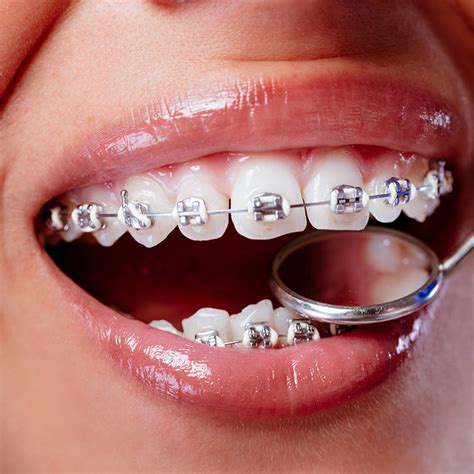 brackets de metalicos|brackets dentista.